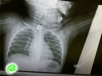 ילדה בת שנה וחצי בלעה תליון מגן דוד