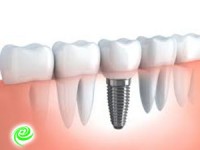 כמה עולה השתלת שיניים? מידע ומחירים