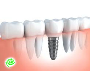 כמה עולה השתלת שיניים? מידע ומחירים