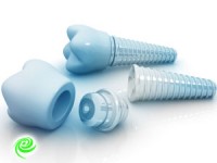 השתלות שיניים – מידע מקיף