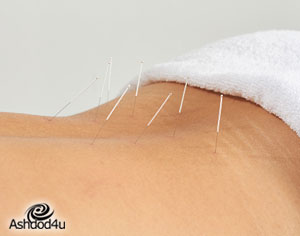 ערב מיוחד בנושא דיקור סיני