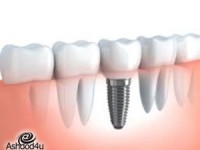 סוגי שתלים דנטליים ויתרונות כל שתל