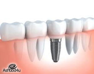סוגי שתלים דנטליים ויתרונות כל שתל