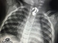 תליון בצורה של עוגן הוצא מגופו של ילד בן שנתיים