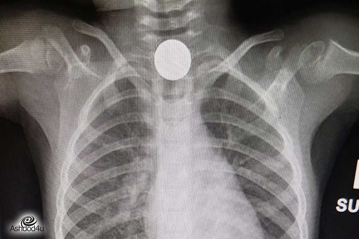 מגופה של ילדה בת ארבע הוצא מטבע של 10 אגורות - האב: "קרה לנו נס"