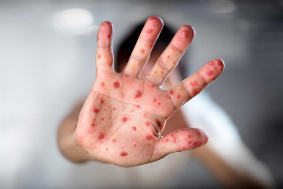 חצבת: כל מה שצריך לדעת