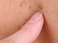 בדיקת נקודות חן עצמית ובמרפאה לבדיקת שומות