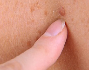 בדיקת נקודות חן עצמית ובמרפאה לבדיקת שומות