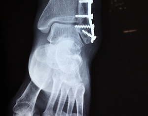 נקעה הקרסול בדרך לאוטובוס: מי תשלם? אגד תעבורה או עיריית אשדוד?