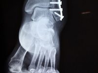 שבר קרסול - יקבל 400 אלף ₪.