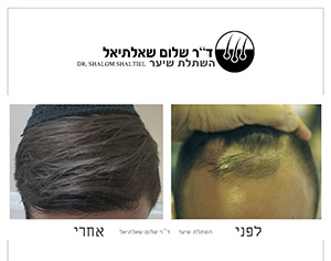 מתעניין בהשתלת שיער?