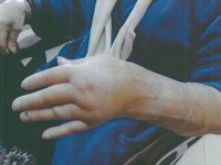 נפלה, שברה את ידה ותובעת את העירייה ואת קבלן התשתיות שלה