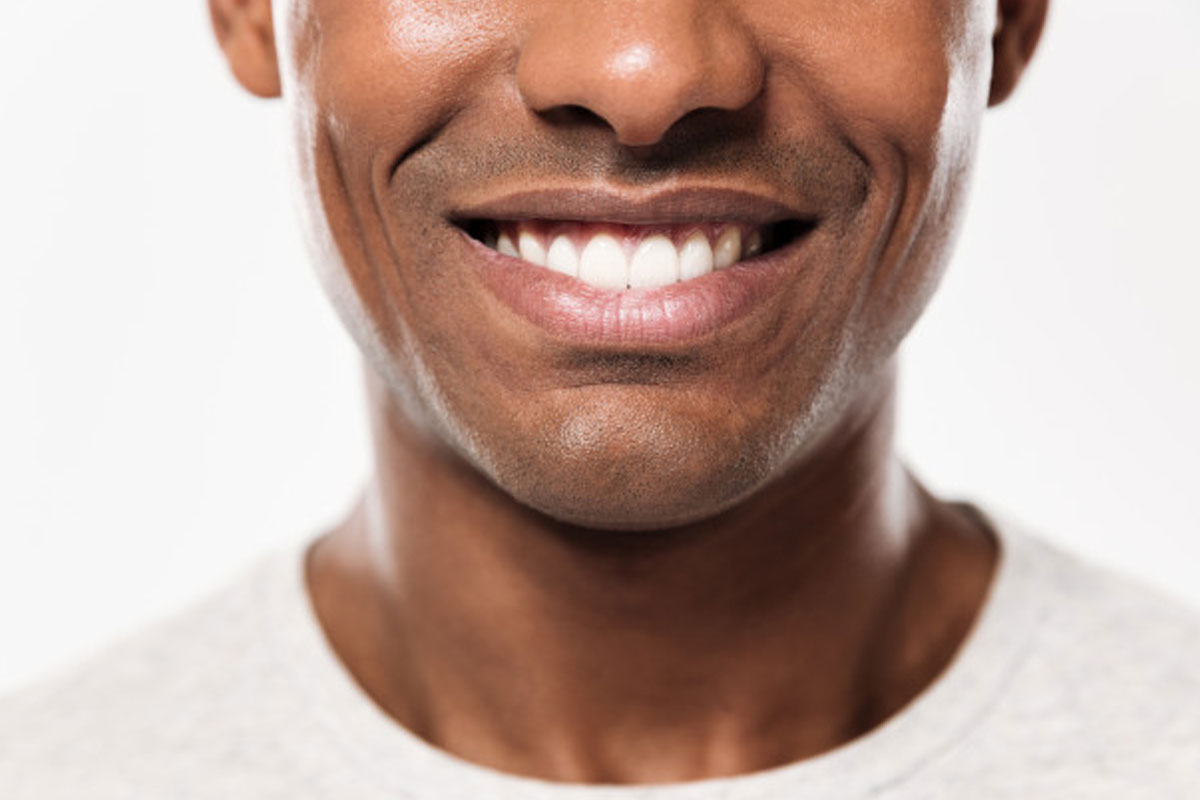 כל מה שצריך לדעת על הלבנת שיניים