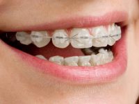 יישור שיניים שקוף – למי זה טוב? 