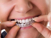 מדוע מומלץ ליישר שיניים בשיטת אינויזליין?  