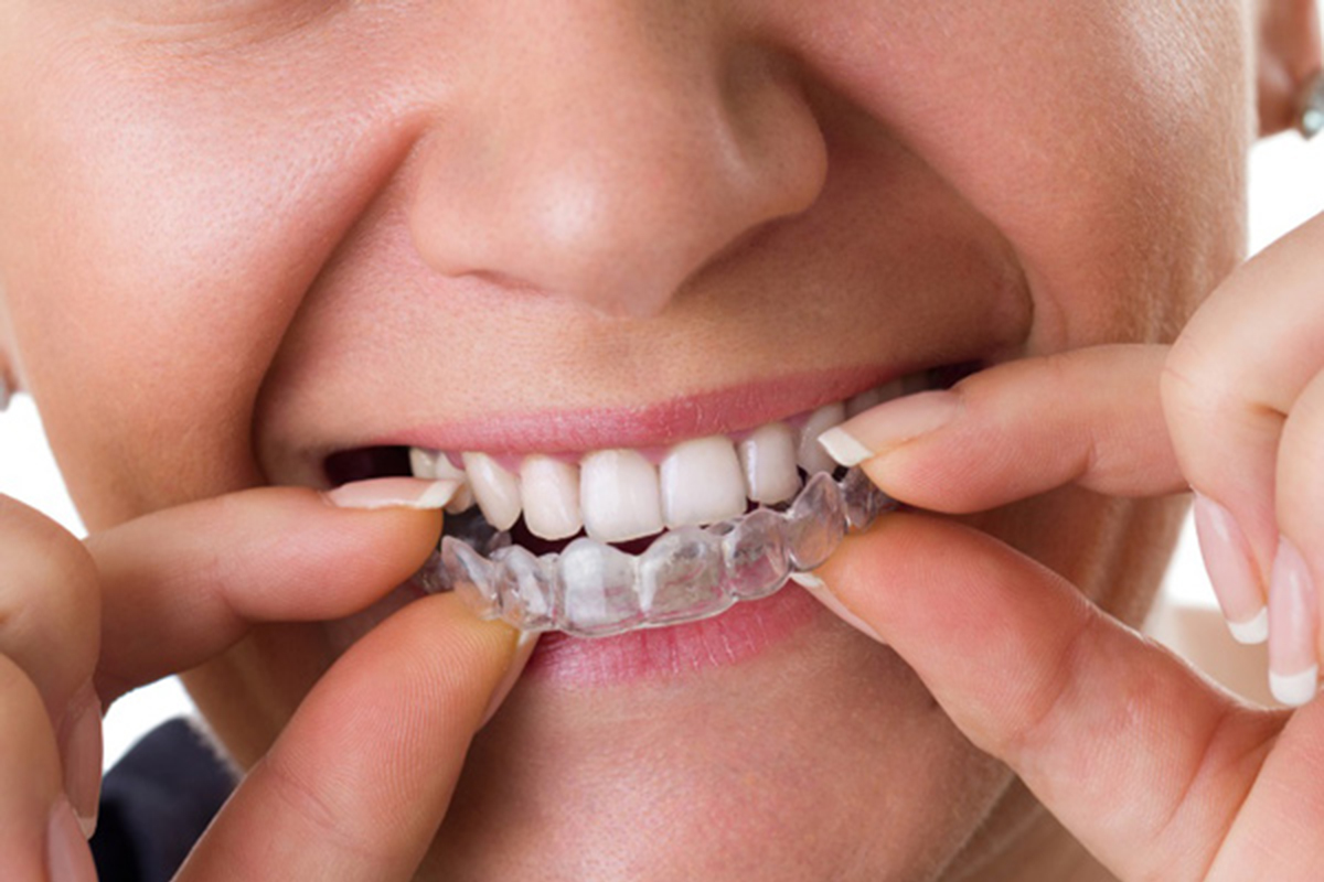מדוע מומלץ ליישר שיניים בשיטת אינויזליין?  