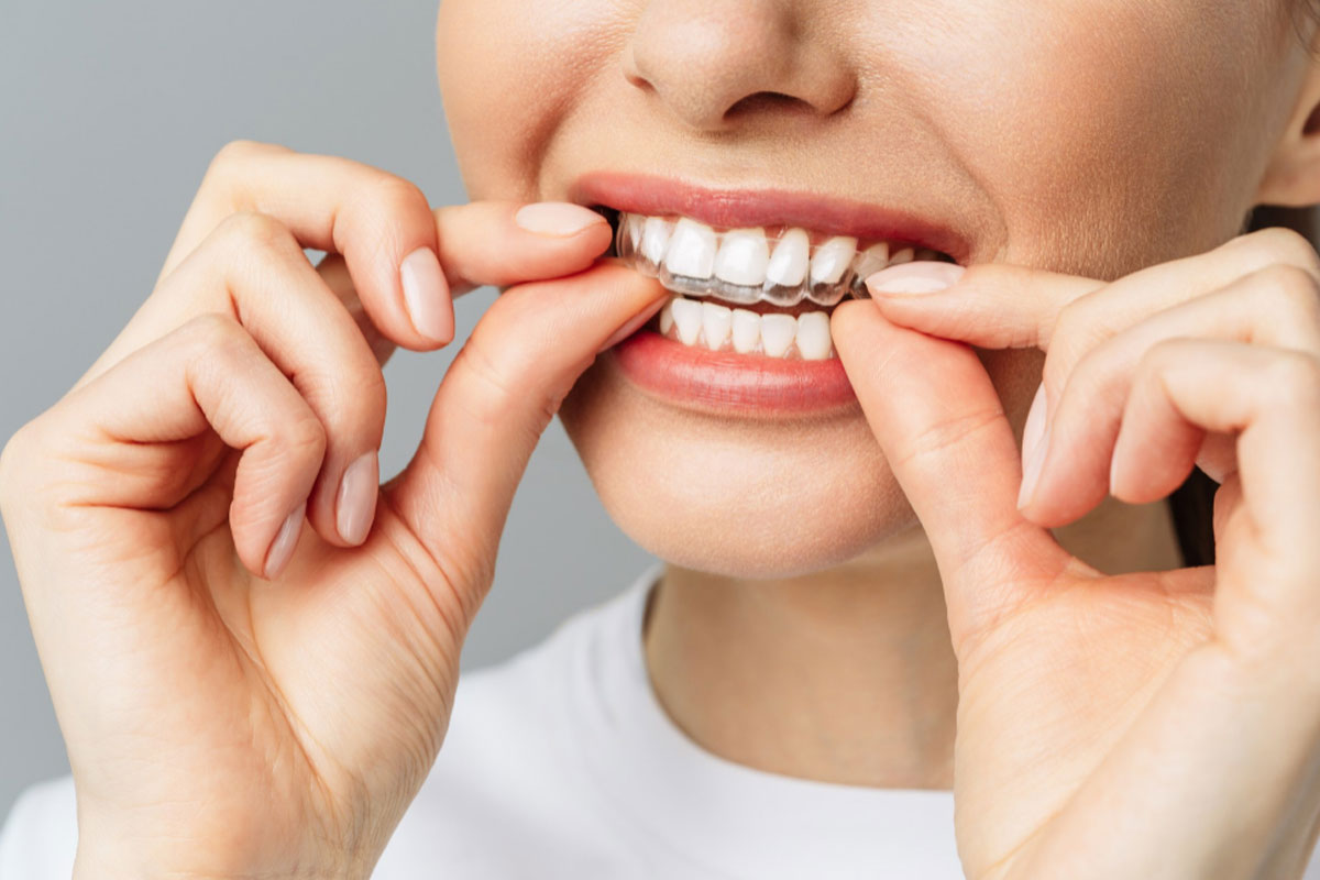 יישור שיניים אינויזליין