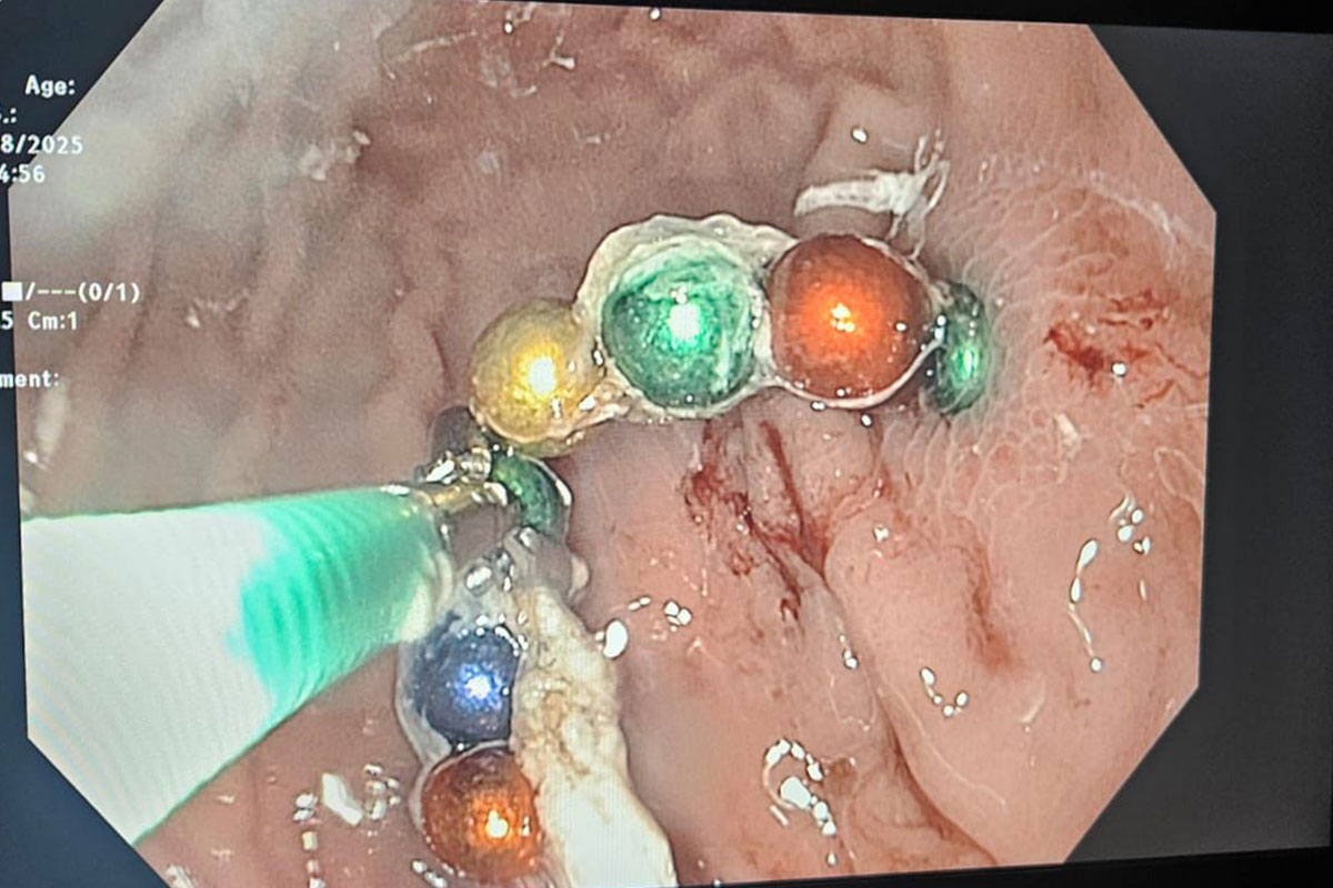 פעוט בלע 12 מגנטים, הרופאים באסותא הוציאו אותם בגסטרוסקופיה דחופה והצילו את חייו